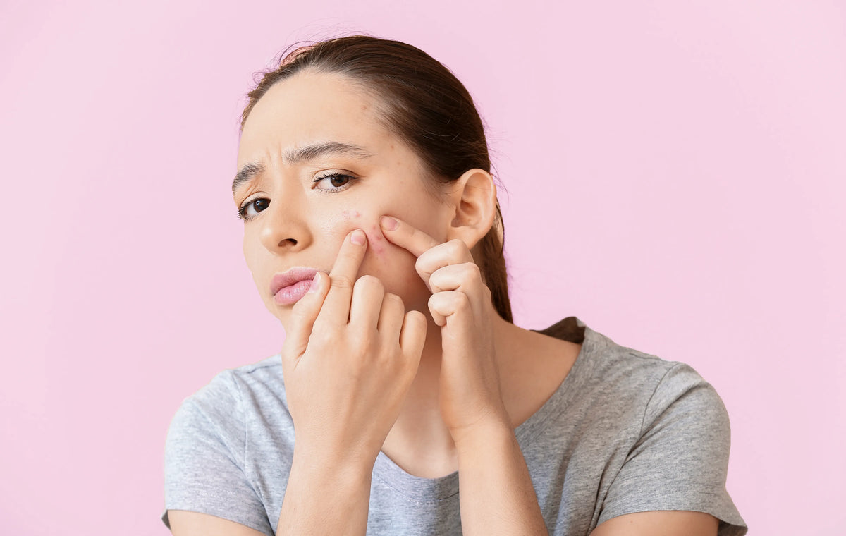 Why Do I Have Acne in My 30s? Franz Skincare USA