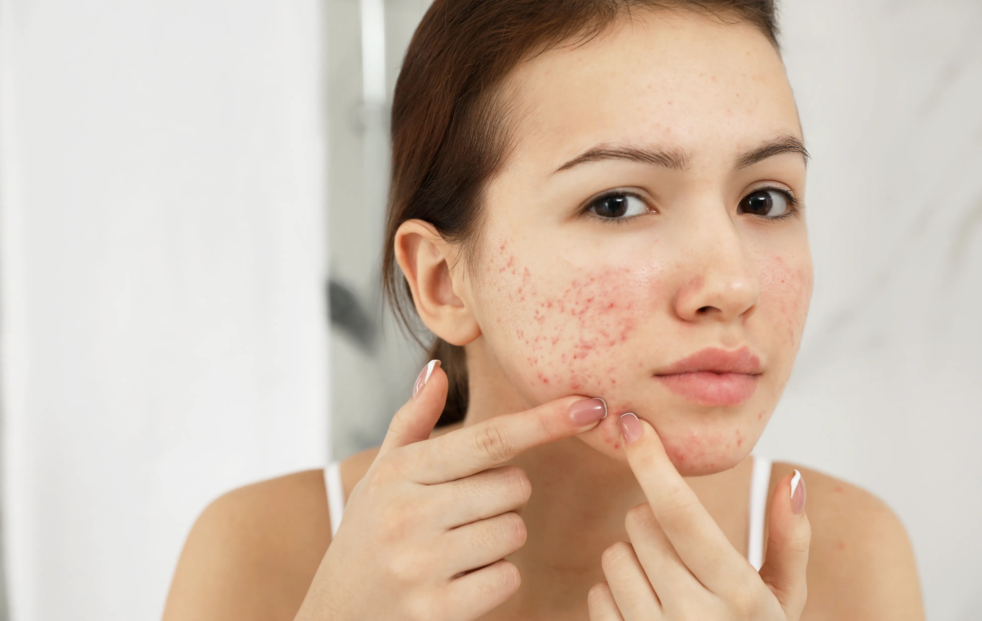 How to Fade Acne Scars, Naturally - Franz Skincare USA