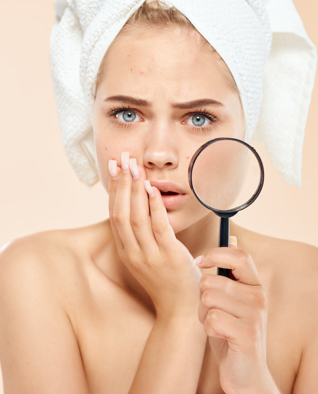 How to Get Rid of Hormonal Acne: The Best Adult Acne Treatment Plan - Franz Skincare USA